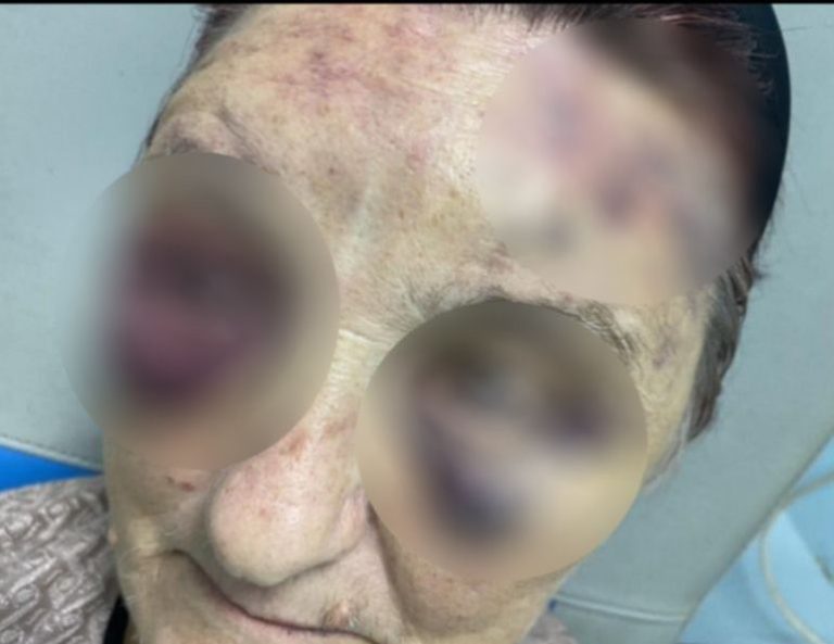 ŠOKANTNA ispovijest žene žrtve nasilja za ‘Avaz’: Suprug me pretukao dok je bio pijan, pobjegla sam bosa da ne budem ubijena
